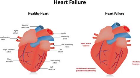 global lv hypokinesia|severe global lv hypokinesis.